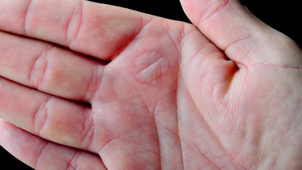 手汗症药物治疗原理是什么 治疗手汗症的药物介绍
