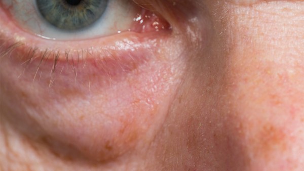 派立明布林佐胺滴眼液的不良反应是什么 布林佐胺滴眼液的注意事项