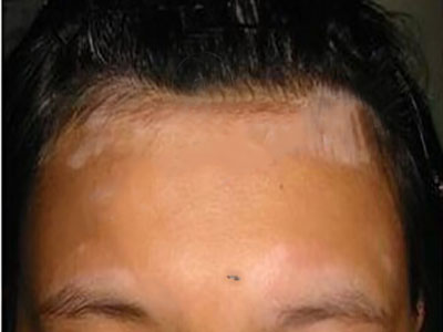 合肥白癜风的患者在护理时要注意什么呢