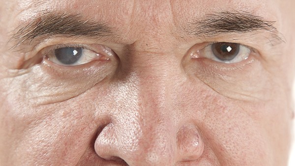 复方尿维氨滴眼液可以用于干眼症吗  复方尿维氨滴眼液有哪些用药禁忌