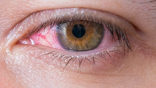 眼睛里出现红血丝怎么办？眼睛里有红血丝离不开这5个因素