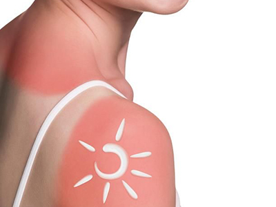 皮肤晒伤起鸡皮疙瘩(皮肤被晒后起了鸡皮疙瘩) 皮肤晒伤起鸡皮疙瘩(皮肤被晒后起了鸡皮疙瘩)