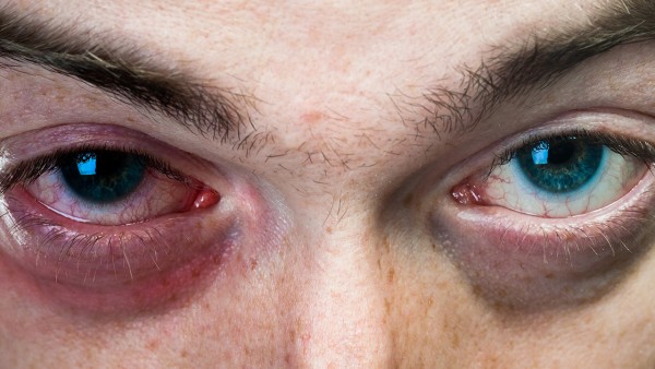 窄角型青光眼的患者能用噻托溴铵粉雾剂吗 噻托溴铵粉雾剂的功效