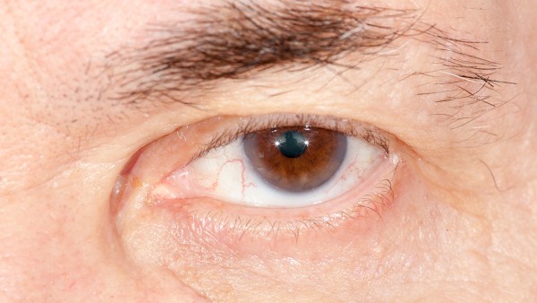 复方磺胺甲噁唑钠滴眼液多久一个疗程  复方磺胺甲噁唑钠滴眼液的注意事项