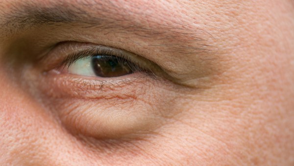 双氯芬酸钠滴眼液能长期用吗 双氯芬酸钠滴眼液的注意事项