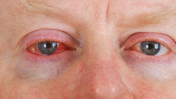 氯替泼诺混悬滴眼液的不良反应有哪些  怎么预防副作用的发生