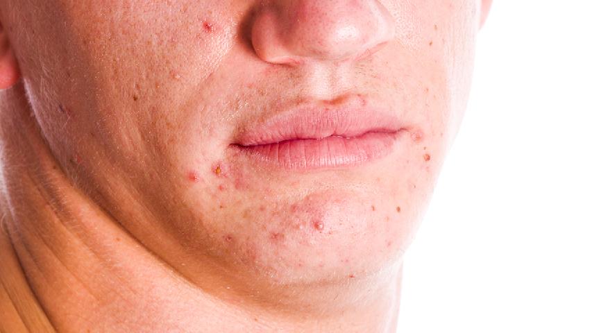 鼻翼长痘的原因是什么？鼻翼长痘痘怎么办？