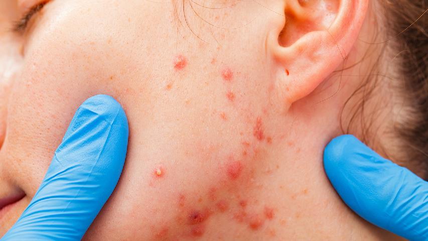 经期脸上长痘痘是什么原因？怎么能治好痘痘？
