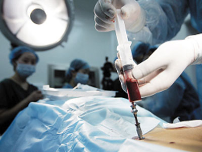 骨髓移植治疗mds需要多少钱?