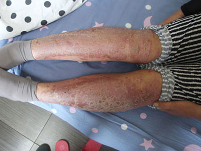 银屑病治疗医院排名_治疗银屑病的药膏图片(3)