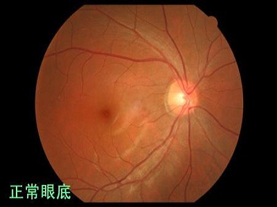 视神经萎缩常见的病因都是什么?