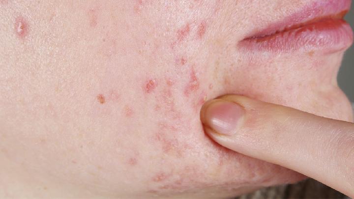 来月经前脸上长痘痘是什么原因？如何避免经期长痘？