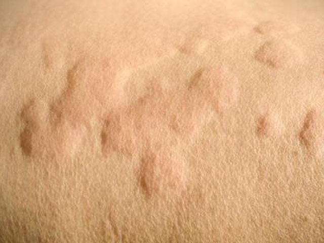 小儿荨麻疹可以自愈吗? - 复禾健康