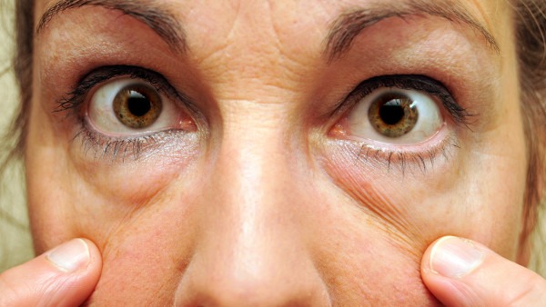 去眼袋后眼窝凹陷该怎么办 玻尿酸填充眼窝凹陷效果如何