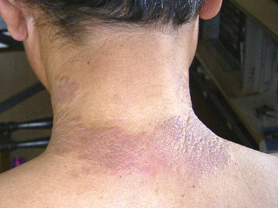 养生问答:冬季皮炎患者多吃什么好?