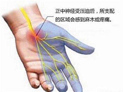 手指痛如何鑑別是鼠標手還是頸椎病