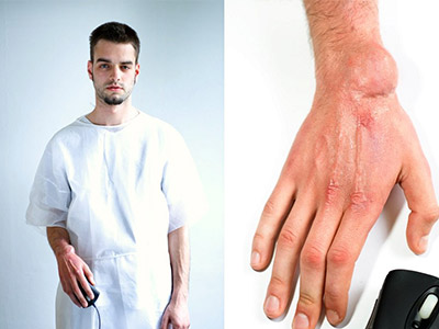 治疗鼠标手该怎么做?