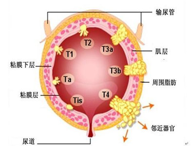 在治疗上,早期膀胱癌可以保留膀胱,患者生存率非常高.