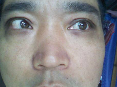 额头突然出现很多皱纹是怎么回事