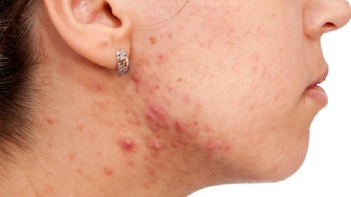 40岁女人下巴长痘痘是什么原因？下巴长痘痘需要注意什么？