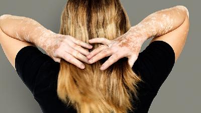 女性白癜风什么原因引起的