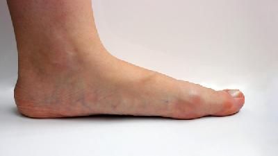 脚气是怎么引起的  女性脚气初期图片