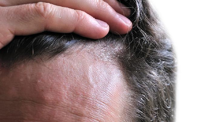 掉头发严重是什么原因?脱发的九种原因