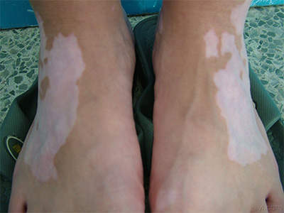 白癜风是一种以黑色素脱失和白斑形成为特征的常见色素障碍性皮肤病