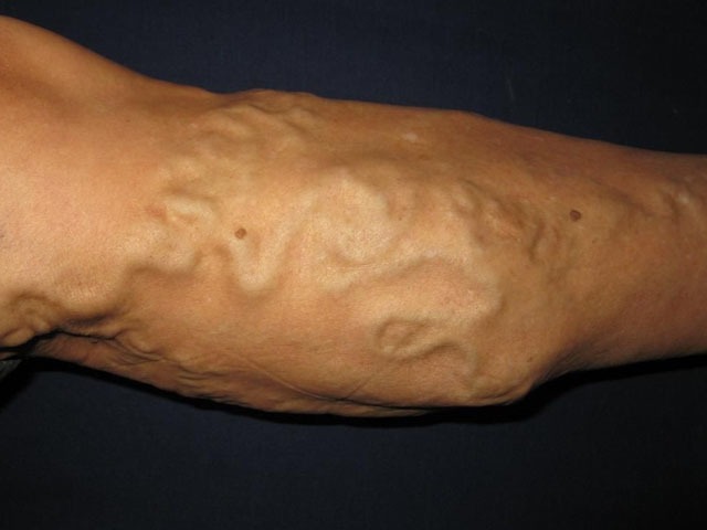 静脉曲张是怎么引起的静脉曲张的原因无解