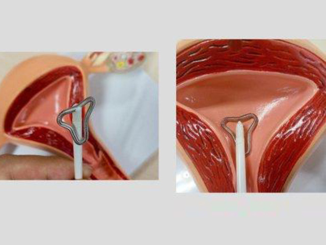 宫腔镜取环手术过程图图片
