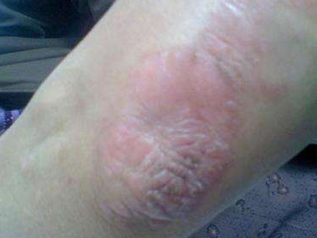 皮炎都有哪些症状 这些症状才是最常见的