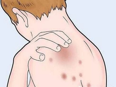 [夏季如何预防湿疹]如何预防湿疹
