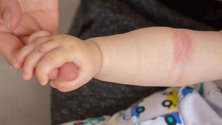 宝宝湿疹饮食要注意什么？治疗婴儿湿疹的食疗方有哪些？