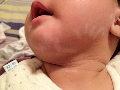 婴幼儿白癲风早期图片 [婴幼儿白癜风的护理主要有哪几个?] 