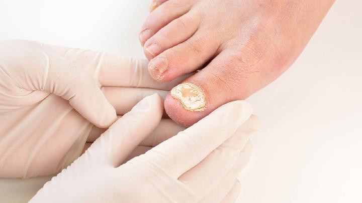 穿灰指甲患者的拖鞋會傳染嗎真菌病傳染源避免同用物品