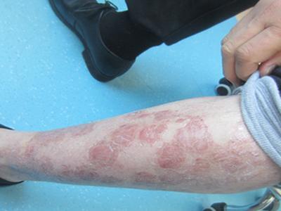 银屑病治疗医院排名_治疗银屑病的药膏图片(3)