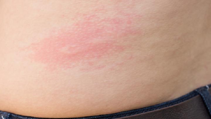 婴儿湿疹的防治方法有哪些？