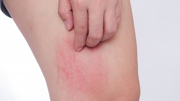 肤痒颗粒对慢性荨麻疹有效吗
