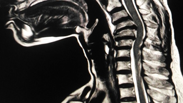 颈椎脊髓水肿多长时间可以恢复