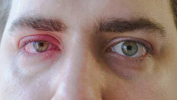 霰粒肿患者可以用左氧氟沙星滴眼液吗