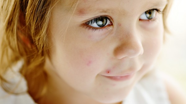 压痕性荨麻疹的病因是什么