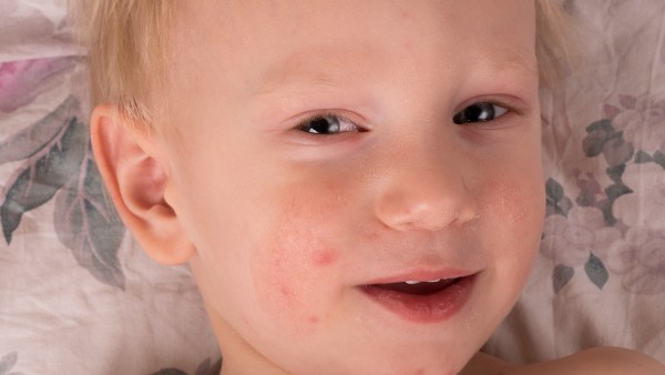 荨麻疹能不能引起淋巴结肿大