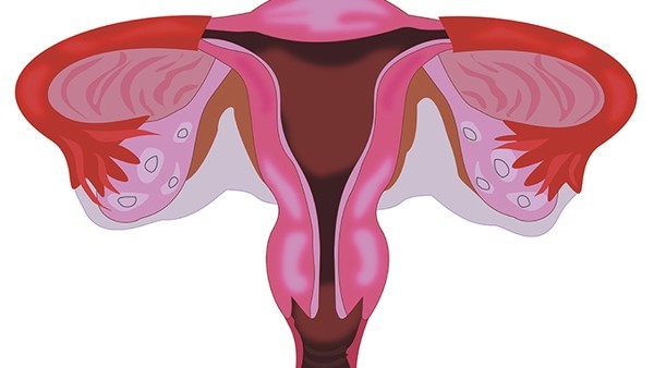 宫颈息肉是不是宫颈癌的初期
