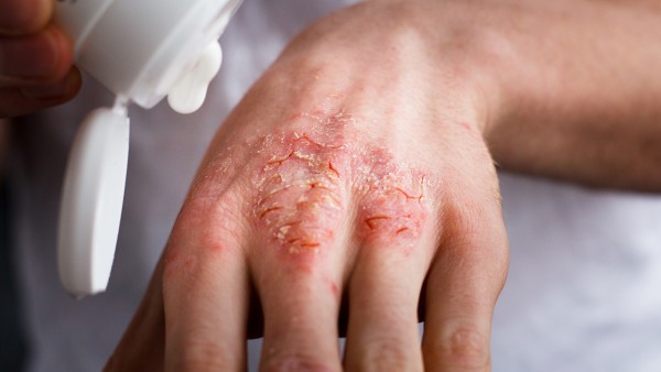 硼酸在治皮肤病中的妙用有哪些