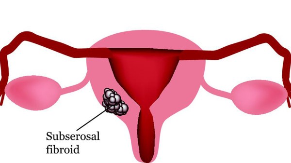 HPV阴性还会得宫颈癌吗
