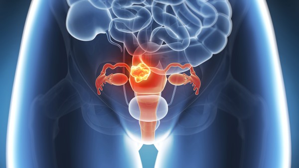 宫颈癌的患者可以吃榴莲吗