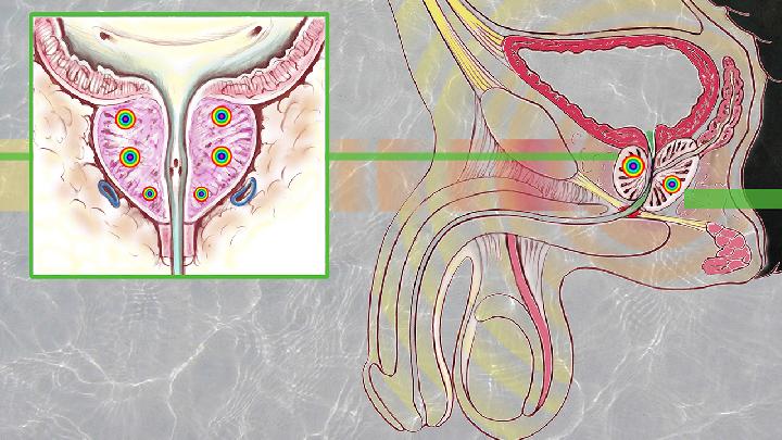 前列腺结石的病因有哪些？前列腺结石的危害有什么？