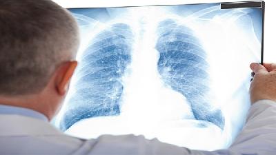 73岁周围型肺癌用微波消融术好使吗？