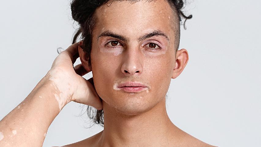 怎么治疗白癜风能进行有效的预防呢