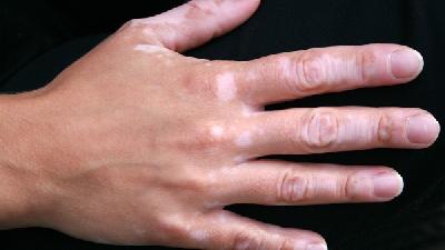 8歲兒童大腿長白斑是白癜風嗎